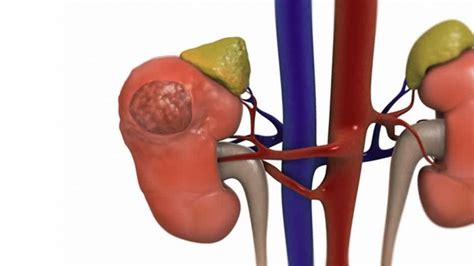 Cáncer Ureteral O Cáncer De Ureter O Cáncer De Pelvis Renal Causas