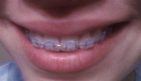 Clear Braces Colored Bands