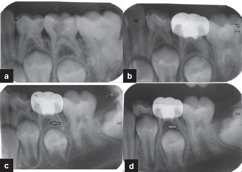 Preoperative And Postoperative Radiographs Of Mandibular Second Primary