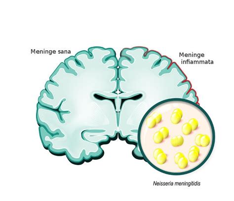 Meningite Fulminante Cos è Cause Sintomi e Conseguenze