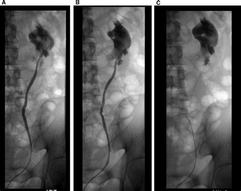 retrograde pyelography   patient  recurrent ureteropelvic