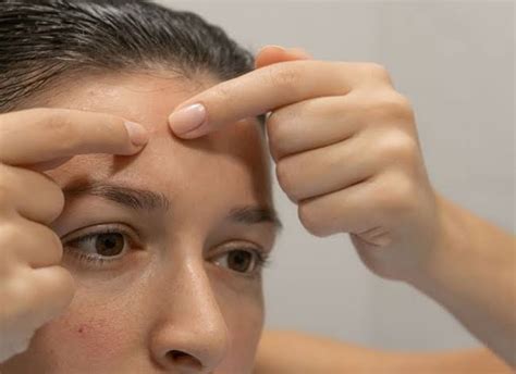 Demystifying Forehead Pimples Causes Prevention And Treatment