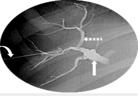 Percutaneous Transhepatic Cholangiography Showing Dilation Of The