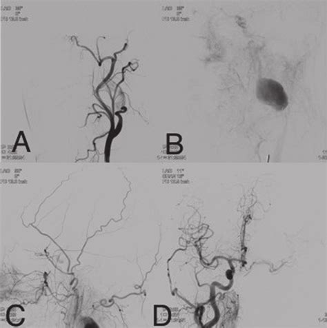 Angiogram A Left Common Carotid Angiogram Left Anterior Oblique Lao