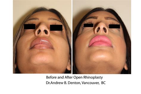 Before And After Open Rhinoplasty Dr Andrew B Denton Vancouver BC