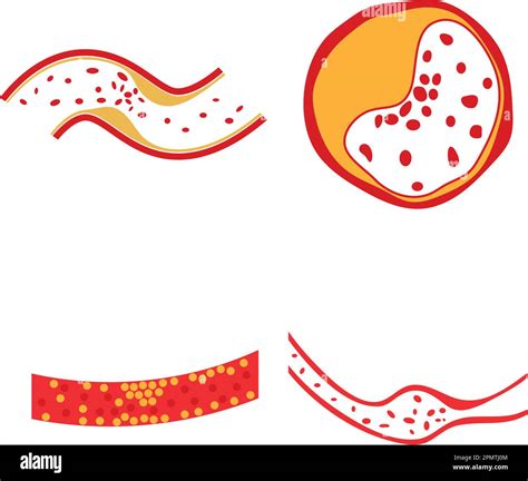 Vector Of Cholesterol Plaque Illustratrion Design Stock Vector Image