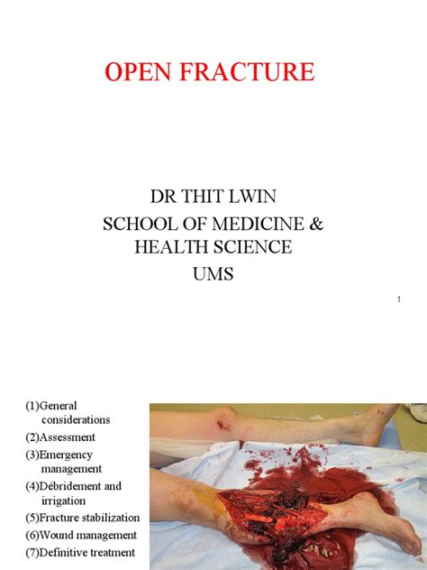 Comprehensive Guide To The Management Of Open Tibial Fractures Pdf