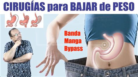 CirugÍa BariÁtrica Para Bajar De Peso 😱 Banda Manga Balón Y Bypass