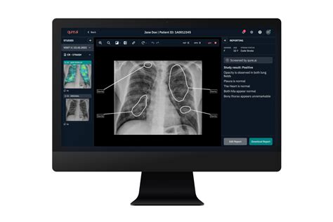 Inhealth To Enhance Telereporting Services With Qure Ai Chest X Ray