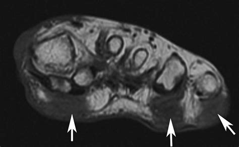 Imaging Of Soft Tissue Lesions Of The Foot And Ankle Radiologic Clinics