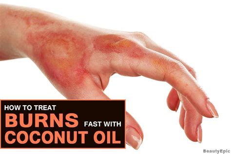 How To Use Coconut Oil For Heal Burns Coconut Oil For Burns Treat