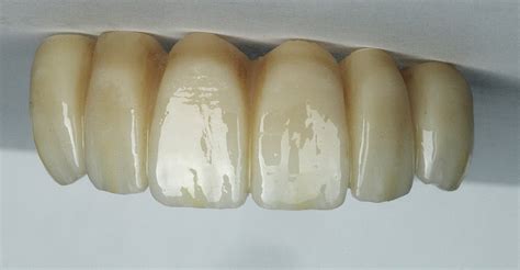 Monolithic Zirconia Scullin Dental Lab