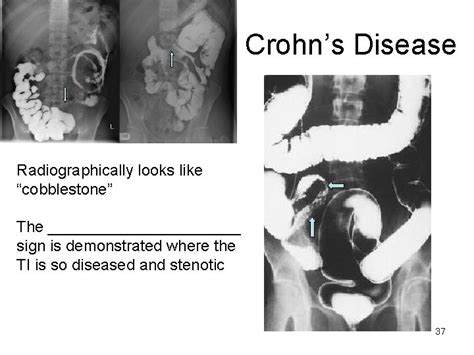 Abdomen Gi System Final Rt 91 Pathology Spring