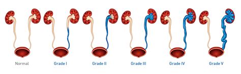 How Is Vur Diagnosed And Graded Deflux