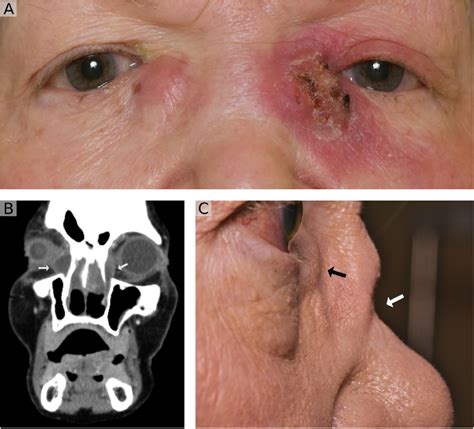 Bilateral Dacryocystitis Resulting From Granulomatosis With