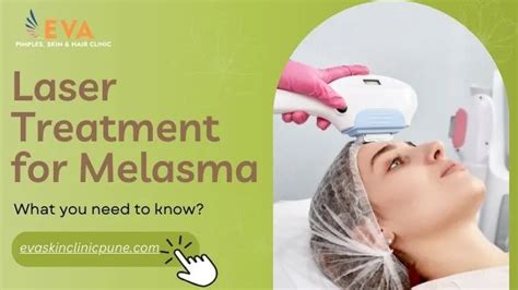 Laser Treatments For Melasma What You Need To Know