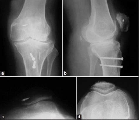 Postoperative Radiographs Anteroposterior A And Lateral Views B Of