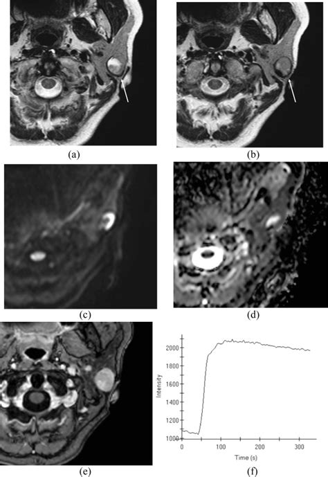 Evaluation Of MR Imaging Findings Differentiating Parotid Basal Cell