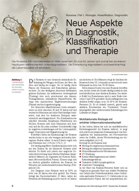 Rosazea Teil 1 Ätiologie Klassifikation Diagnostik Neue Aspekte