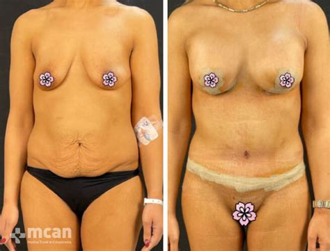 Tummy Tuck Turkey MCAN Health