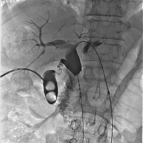 Radiofrequency Ablation Was Performed To The Distal Common Hepatic Duct