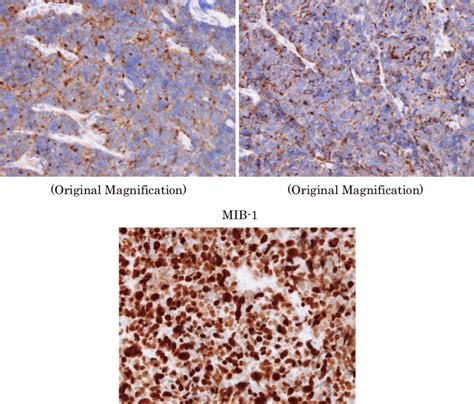 Figure Immunohistochemical Staining Revealed That The Tumor Cells Were