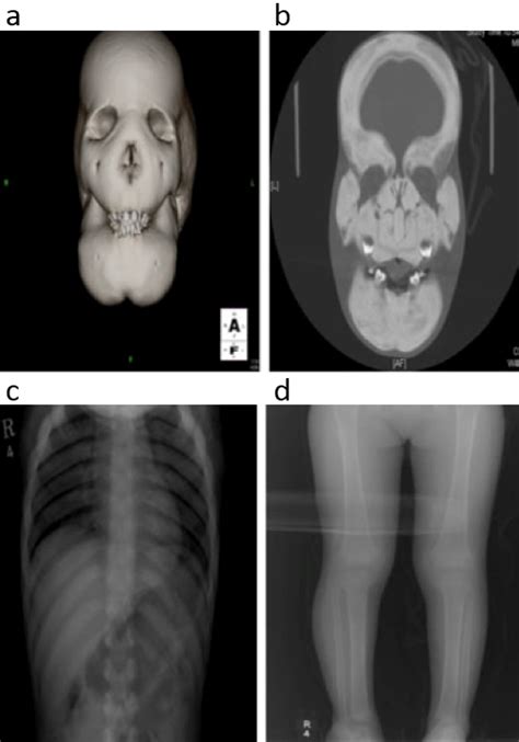 Craniodiaphyseal Dysplasia Skull