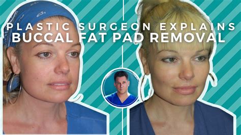 BUCCAL FAT PAD REMOVAL Surgery Recovery Before And After YouTube