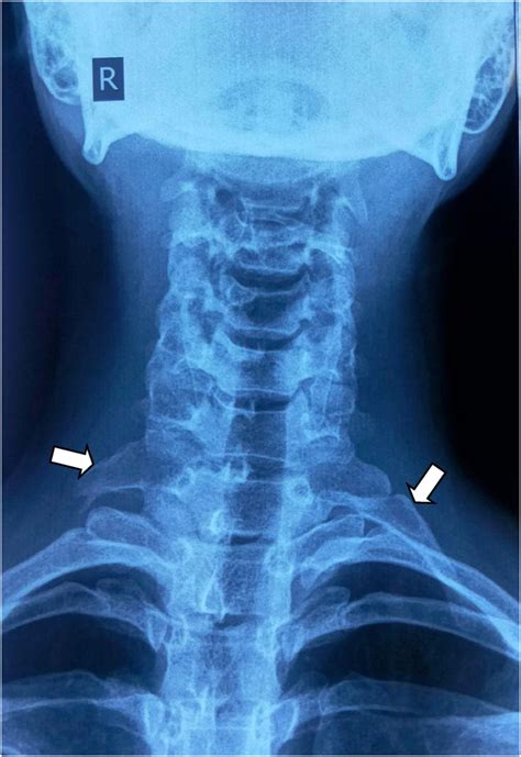 Cervical Rib Case Series From A University Hospital Of Nepal