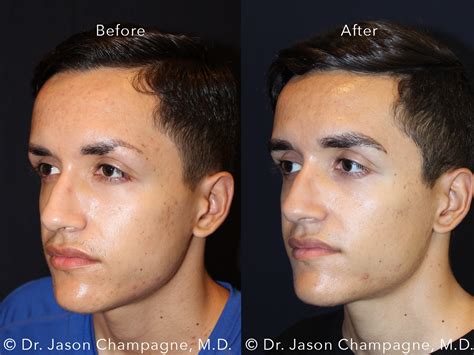 Eyebrow Hair Transplantation Gallery Beverly Hills Plastic Surgeon