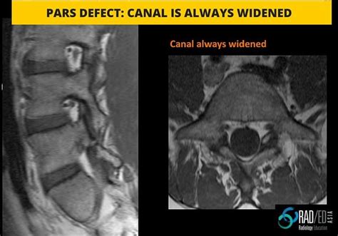 Spondylolisthesis: Pars Defect or Degen. How to differentiate quickly ...