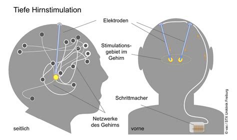 Tiefe Hirnstimulation bei Zwangsstörungen Ärzte fordern besseren