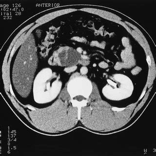 Abdominal Enhanced Computed Tomography Scan Showing Multilobular Cystic