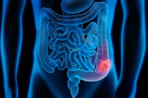 Strange Colon Discovery Explains Racial Disparities In Colorectal Cancer Uva Today