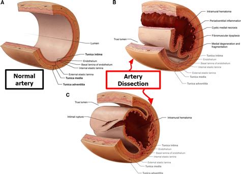 Vertebral Artery Segments, Stenosis and Artery Dissection Symptoms