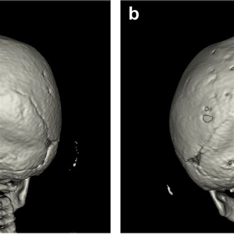 Volume Rendered 3 Dimensional Computed Tomography Images Without Download Scientific Diagram