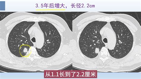 肺结节ct片怎么看？医生举例解析，这个肺癌3年长大1倍高清1080p在线观看平台腾讯视频