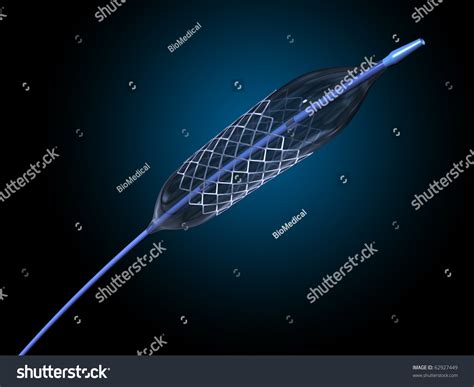 stent  inflated balloon stock illustration  shutterstock