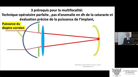 Chirurgie de la cataracte évolution technologique des implants