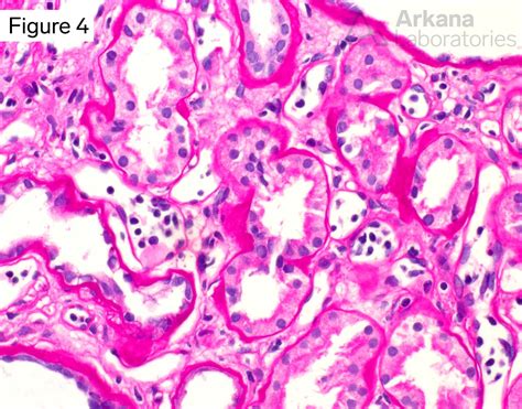 Chronic Antibody Mediated Rejection | Diagnose This!