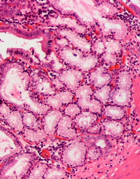 Difference Between Cholecystitis And Cholelithiasis Compare The