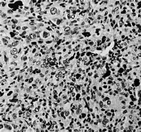 Uterine Sarcoma: Histology, Classification, and Prognosis | GLOWM