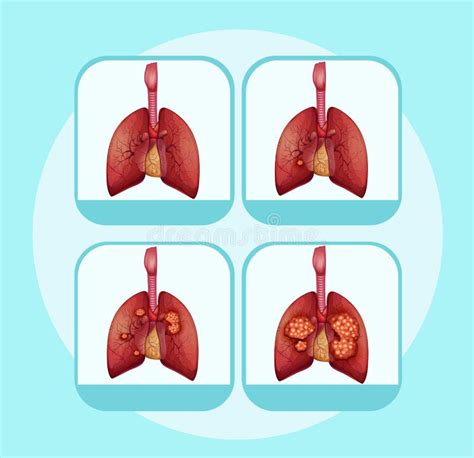 Diagram Showing Different Stages Of Lung Cancer Stock Vector