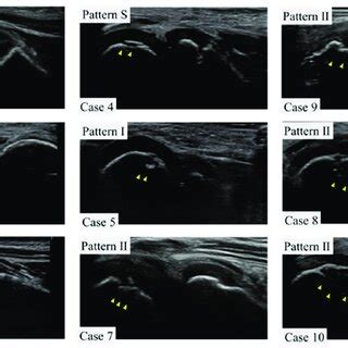 Ultrasound images of the lateral elbow for each case in this study. For... | Download Scientific ...