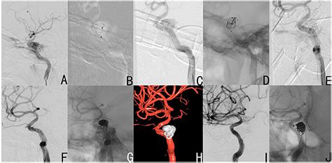 Frontiers A Modified Treatment Through Point To Point Coil Embolization For Direct Carotid