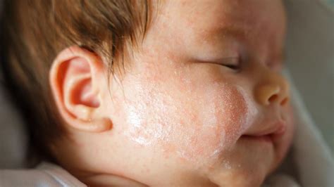 Dermatitis At Pica Una Enfermedad Que Se Triplica Y Puede Dejar Secuelas