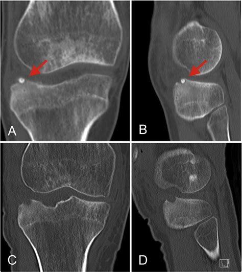 Intra Articular Osteoid Osteoma In The Proximal Tibia And Its Imaging