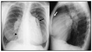 Approach To Pulmonary Hypertension Pptx