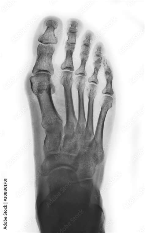 X Ray Normal Human Foot Top View Stock Photo Adobe Stock