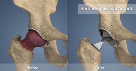 Understanding Bipolar Hemiarthroplasty Vs Total Hip Replacement Jain